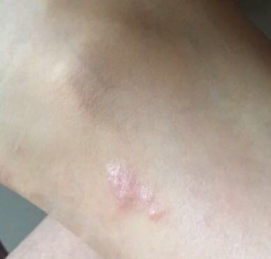 推荐一下最有效的祛疤膏,推荐一款祛疤膏