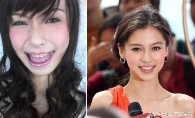 林允整牙效果怎么样,林允整牙后变化图片