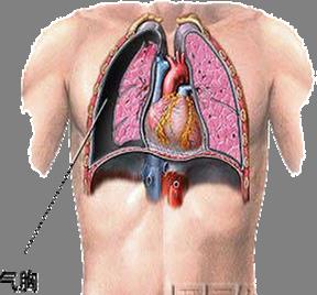 多发性气胸护理要点,气胸穿刺排气的护理
