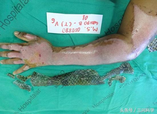 烫伤了不痛,鱼皮治疗烫伤疤痕可以吗