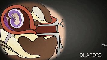 到底是人流还是药流怎么选太纠结,哺乳期选择药流还是人流