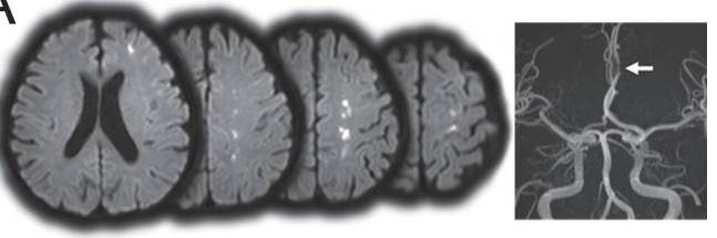 大脑前动脉梗死属于小动脉梗死吗,左侧大脑中动脉闭塞大面积梗死