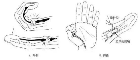 手机玩多了大拇指疼痛一招搞定,手机玩多了小拇指变形疼痛