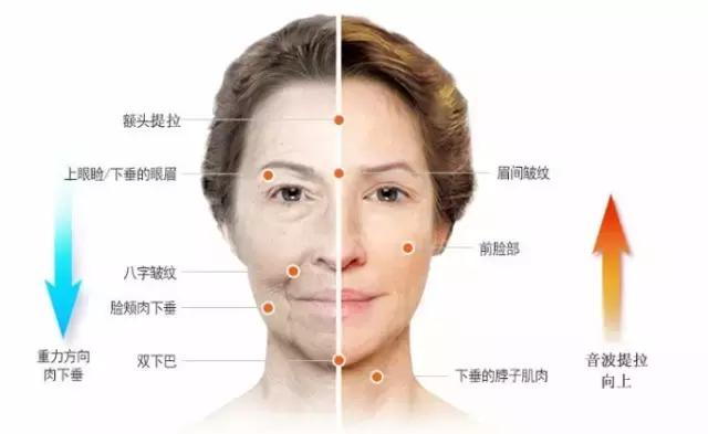 做线雕多久可以敷面膜,敷100次面膜不如打一次水光图片