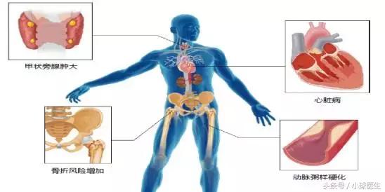 继发性甲状旁腺功能亢进是什么病,继发性甲状旁腺功能亢进怎么治