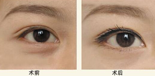 鼻子整形保质期多久,整形维护期大概是多久