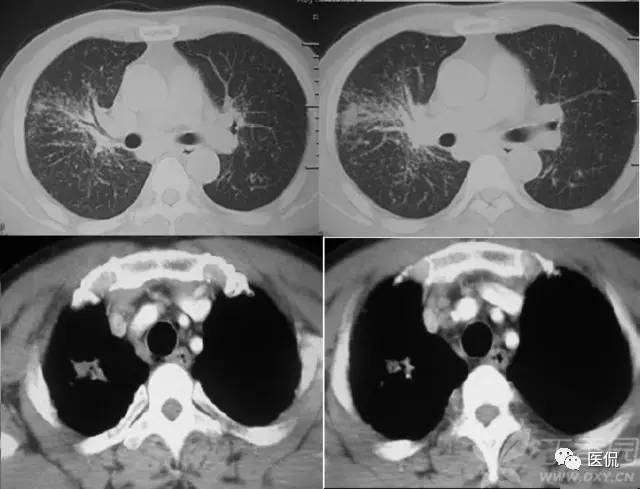 影像学呼吸系统理论知识,呼吸系统疾病影像学常见征象