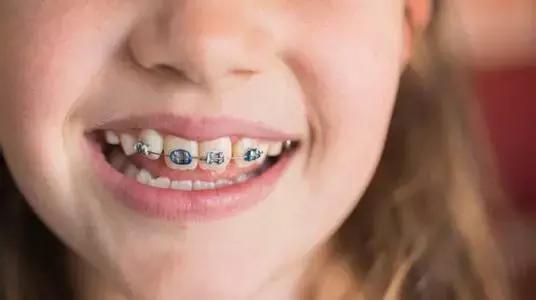 儿童牙齿矫正最佳时间及注意事项,儿童牙齿矫正黄金期推荐