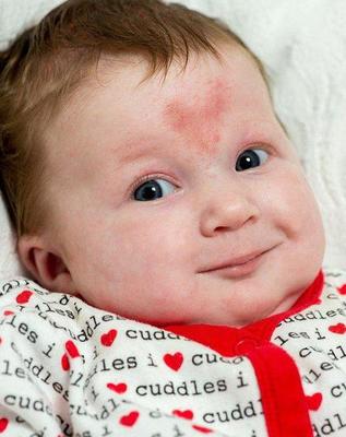 胎记如何治疗才可以不长,胎记能随着年龄的增长而消失吗