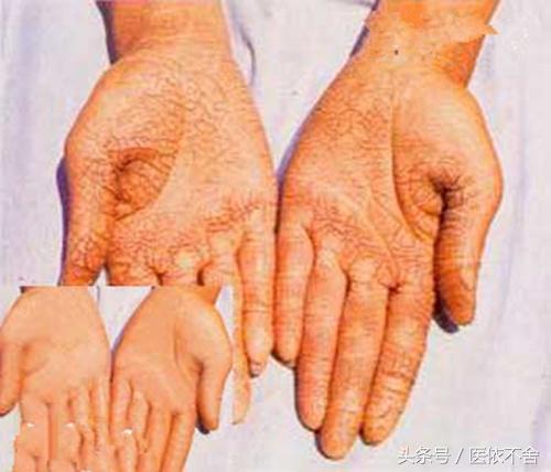 天气冷手脚干裂怎么办,秋冬季节手脚干裂用啥药