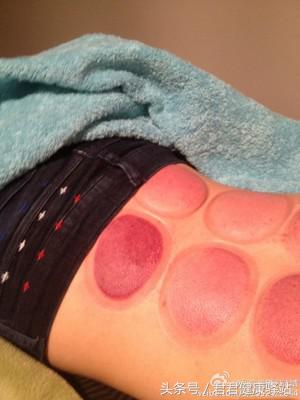 拔火罐印记是灰白颜色为什么,拔火罐的印子颜色代表了什么