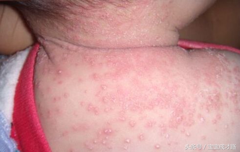 小孩咳嗽能用干柚子皮治疗吗,便秘吃西瓜皮有用吗