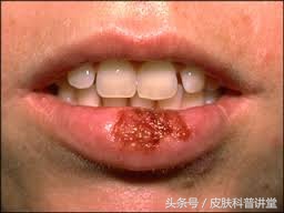 皮肤科疱疹,皮肤科一问一答
