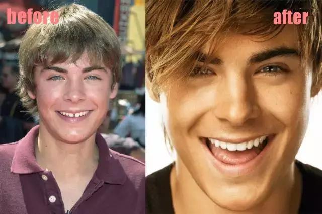 整牙=整容？看杨幂、刘涛、高圆圆为你亲身示范！