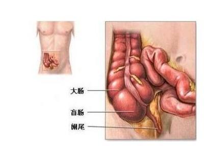 得了阑尾炎要不要割了阑尾,得了阑尾炎不管他会怎么样