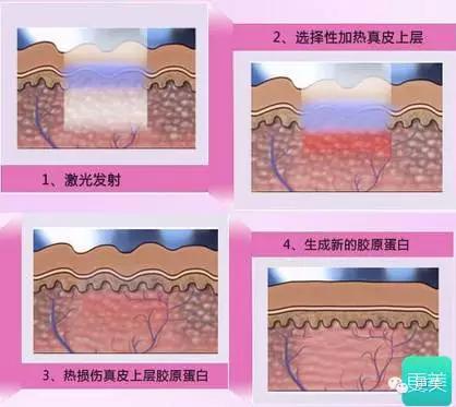长痘痘好焦虑啊,长痘痘要用什么药治疗