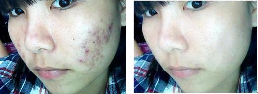 有什么方法祛痘有效最快,如何祛痘痘最有效的方法教给你