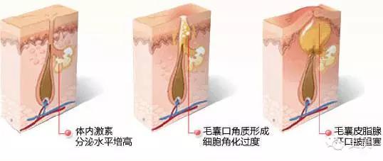 长痘痘好焦虑啊,长痘痘要用什么药治疗