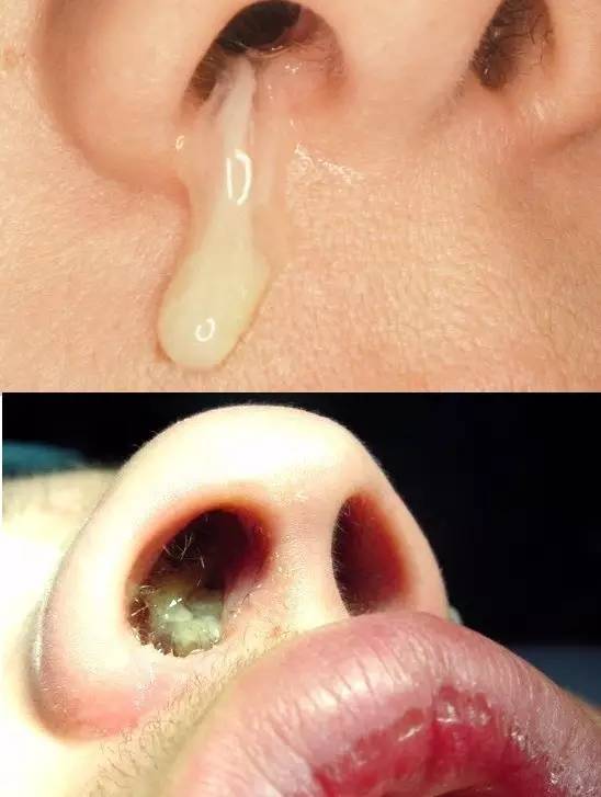 宝宝清鼻涕变黄鼻涕鼻塞好方法,清鼻涕的正确方法图片