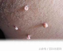 恶性肿瘤身上有很多包是咋回事,身上长个包是恶性的是什么意思