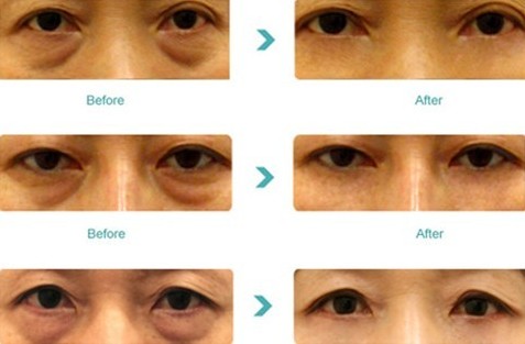 通过手术去眼袋有什么后遗症,内去眼袋手术有什么并发症