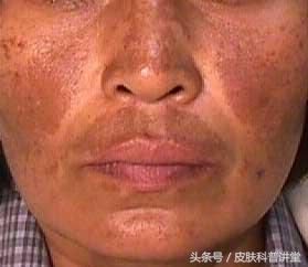 身上的褐斑慢慢长大了该怎么办,褐斑的原因及治疗方法