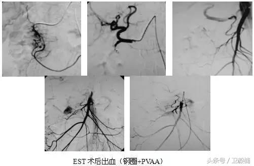 微创介入科一卫毅楠,什么是心血管介入治疗