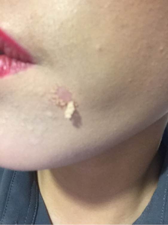 白斑光照,白斑光照后图片