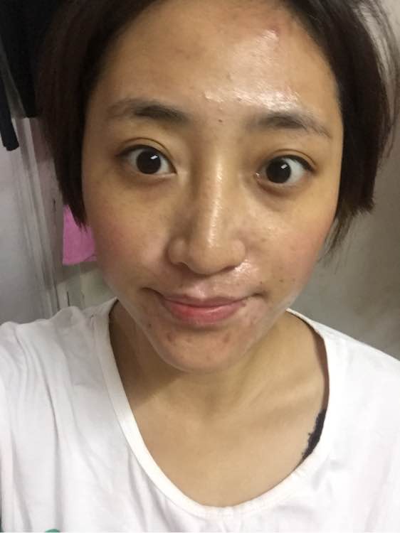 白斑光照,白斑光照后图片