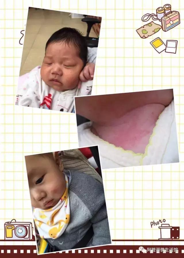 脖子长湿疹怎么治疗效果最好,后背长湿疹是什么原因怎么治疗