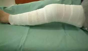 足踝损伤后恢复方法,踝扭伤肌效贴治疗原则