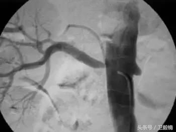 微创介入科一卫毅楠,什么是心血管介入治疗