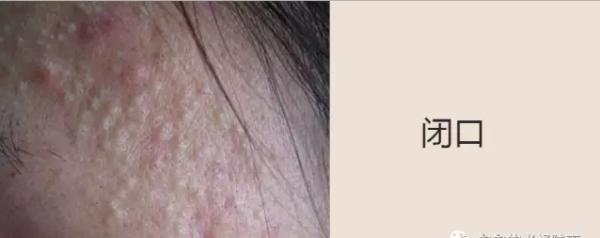 简单又有效的祛黑头方法，今天才是实在的方法