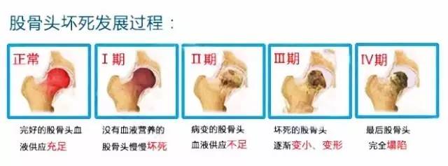 北京积水潭股骨头坏死的治疗方法,北京积水潭专家讲股骨头坏死三期