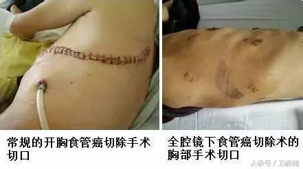 微创介入科一卫毅楠,什么是心血管介入治疗