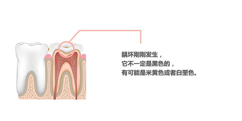蛀牙不补怎么小洞变大了,蛀牙小洞不补大洞受罪