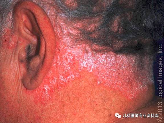 湿疹后有白斑是怎么回事,湿疹后白斑是白癜风