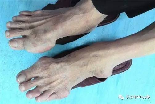 治疗类风湿关节炎的老中医,中医治疗类风湿关节炎案例