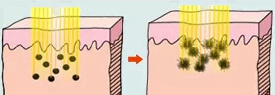 手肘蓝色的痣是胎记,胎记痣的颜色变浅像长到肉里了