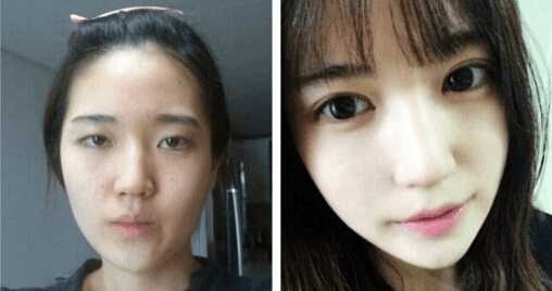 纳米无痕双眼皮埋线怎么恢复得快,埋线双眼皮拆线能恢复到原来吗