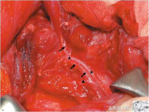 喉返神经的解剖视频,损伤喉上神经和喉返神经的区别