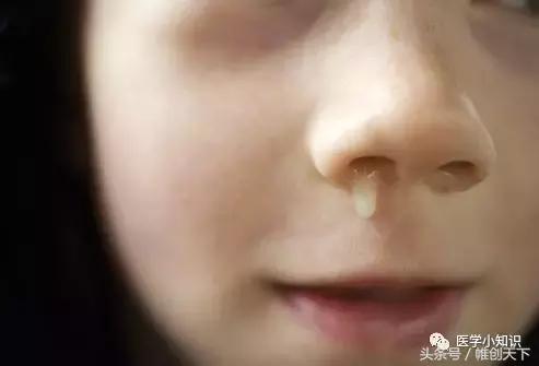 鼻窦炎图片和治疗方法,副鼻窦炎最好的治疗方法