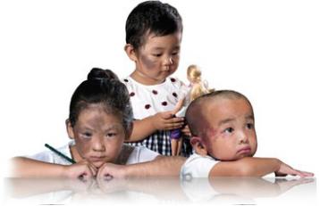 孩子有胎记如何避免孩子自卑,宝宝长胎记怎样避免心理健康