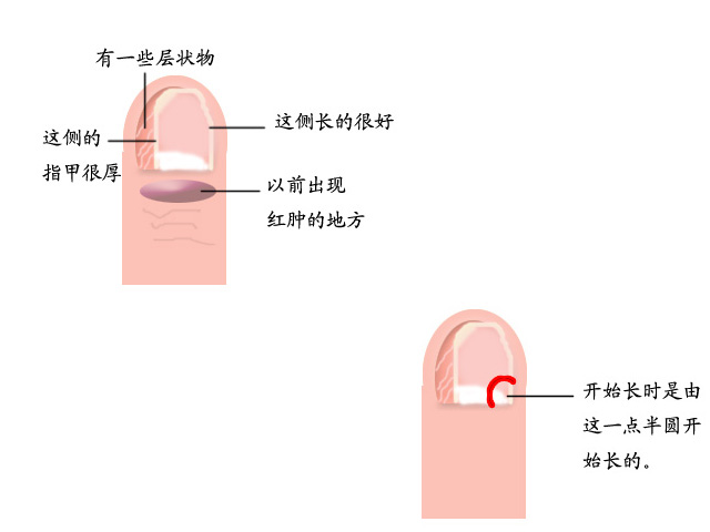 脚趾甲长肉里怎么办最简单的方法,脚趾甲已经长到肉里去了怎么办
