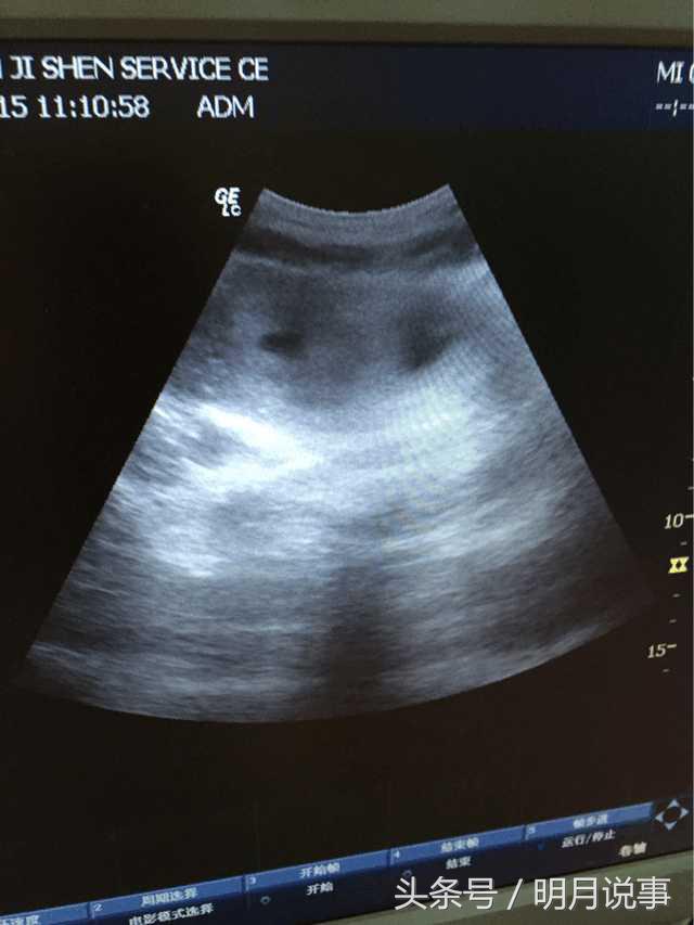 怀双胞胎五个月,怀双胞胎5个半月母体舒服吗