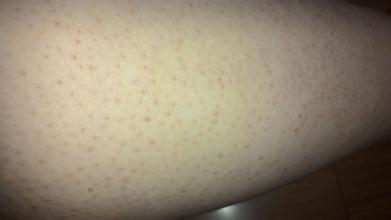 婴儿腿毛孔粗大怎么办毛孔粗大的原因