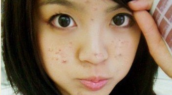 痘痘都是去哪里治好的,三角区长痘痘治疗的全部过程