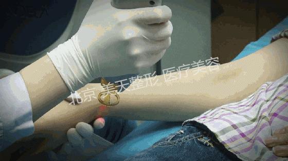 美容店的激光脱毛管用吗,祛斑激光和脱毛激光