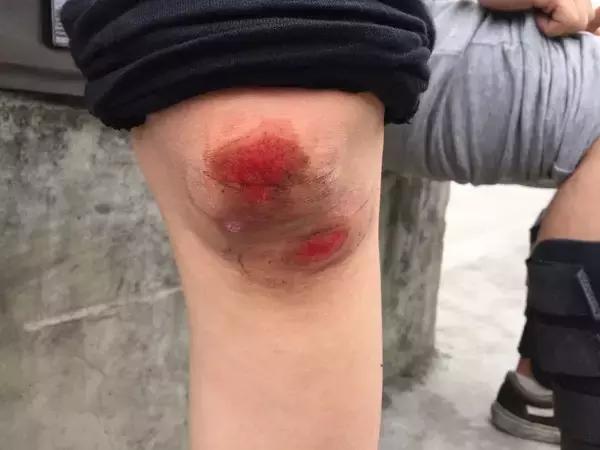 为什么玩滑板老是要摔倒,玩滑板摔倒有多严重