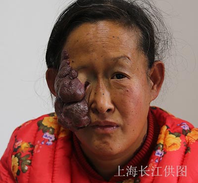 胎记不及时治疗会恶变吗,胎记不治疗对生命有影响吗